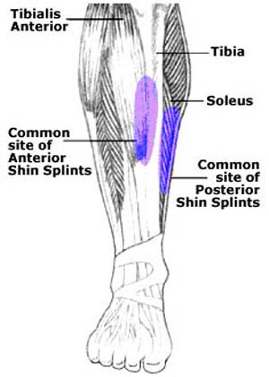 shin splints